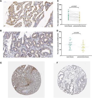 Elevated Expression of Gamma-Glutamyl Hydrolase Is Associated With Poor Prognosis and Altered Immune Signature in Uterine Corpus Endometrial Carcinoma